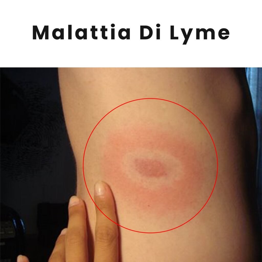 Staying Secure from Lyme Disease in America